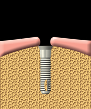 implant dentaire à Repentigny 1