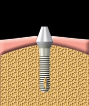 implant dentaire à Repentigny 2