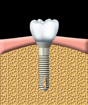 implant dentaire à Repentigny 3
