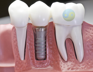 implants dentaires à Repentigny