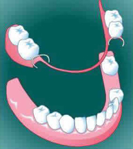 dentier ou implants dentaire