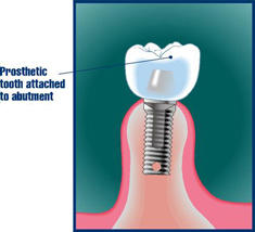 dentier ou implants dentaire