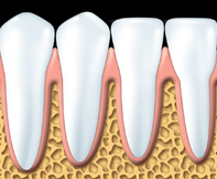 Parodontite - 1 - Dentiste Solution Sourire