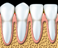 Parodontite - 2 - Dentiste Solution Sourire