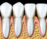 Parodontite - 2 - Dentiste Solution Sourire