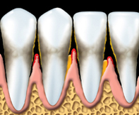 Parodontite - 4 - Dentiste Solution Sourire